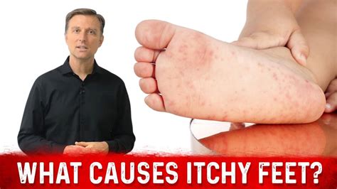 What Causes Itchy Feet And How To Stop It Dr Berg Youtube