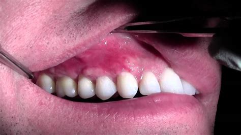 Alloderm Gingival Grafting 3 6 Sites Post Op Healing 2 Weeks Out