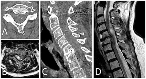 Cureus Spontaneous Spinal Epidural Hematoma Associated With Apixaban