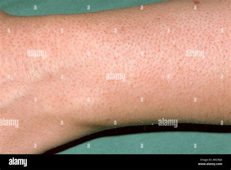 The Arm Of A Patient With Keratosis Pilaris Stock Photo Alamy