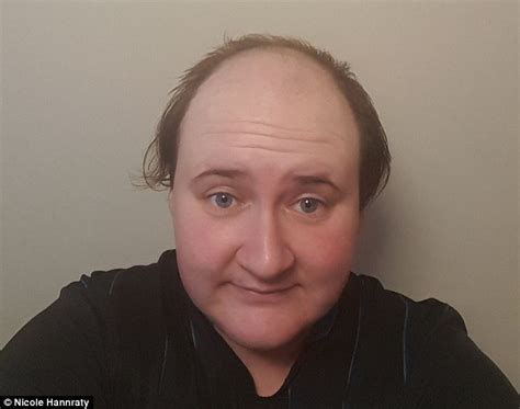 Woman Who Went Bald At Just 20 Says Gluing £250 Hairpieces