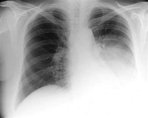 Chest X Ray At Presentation Total Opacification Of The Left Lower Lobe Download Scientific