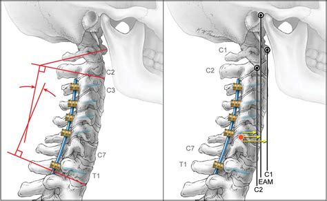 Posts Tagged Cervical Spine Neurosurgery Blog