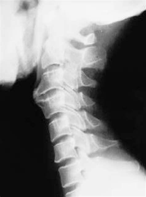 Lateral Radiography Of Cervical Spine It Shows Protruding Large