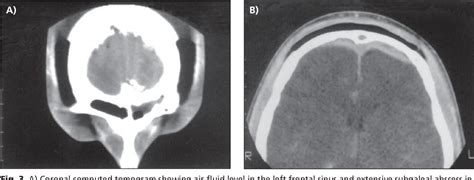 Figure 3 From Extensive Subgaleal Abscess And Epidural Empyema In A