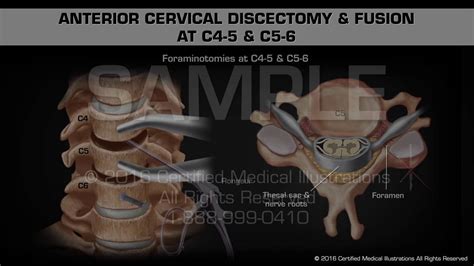 Anterior Cervical Discectomy And Fusion At C4 5 And C5 6 Youtube