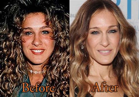Sarah Jessica Parker Plastic Surgery Before And After Nose Job Botox