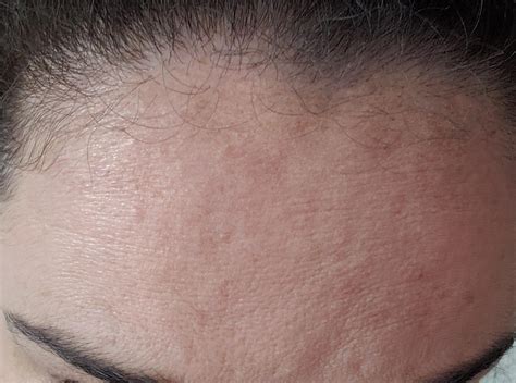 Help With Forehead Textureroutine In The Comments R30plusskincare