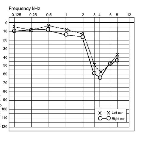 Typical Audiogram Showing A Noise Induced Hearing Loss Download