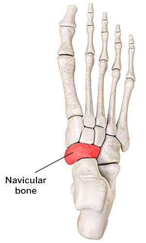 Accessory Navicular Congenital Foot Deformity And Treatments