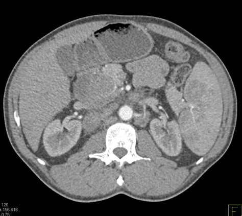 Lymphoma Infiltrates The Head Of The Pancreas And Adrenal Glands And