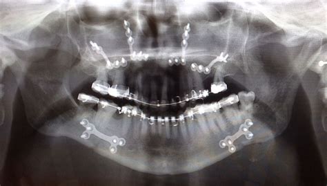 X Ray Showing Metal Plates In The Upper And Lower Jaws After Surgery