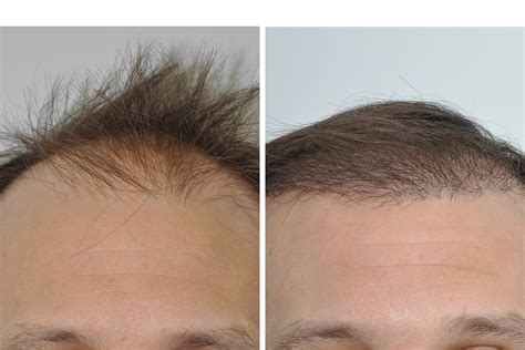 Hair Restoration For Men Dr David Rosenberg