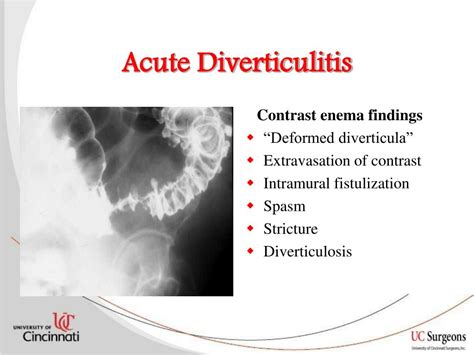 Ppt Practice Parameters For Sigmoid Diverticulitis Powerpoint