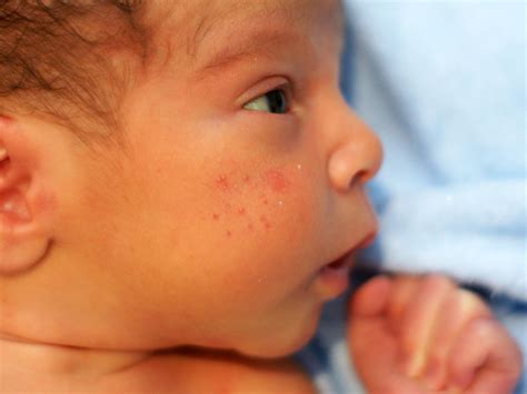 Early Stage Staph Infection In Babies Pictures The Meta Pictures
