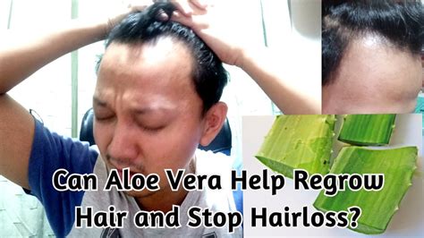 Aloe Vera For Hair Loss Treatment Youtube