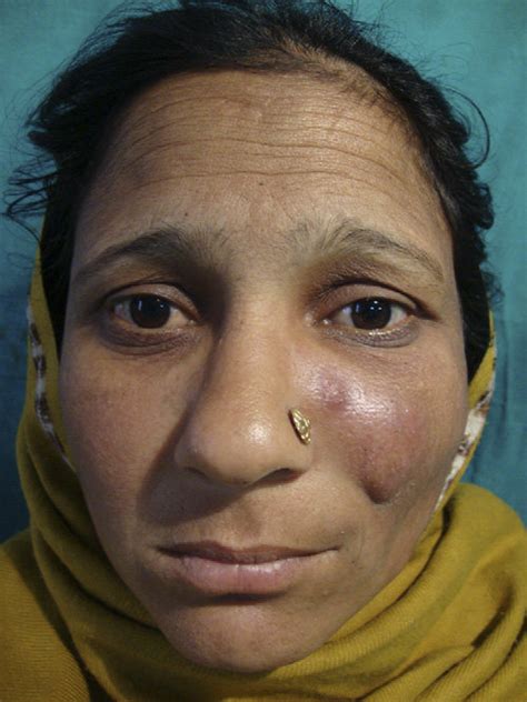 Preoperative Clinical Presentation Of Patient Showing Swelling On Left