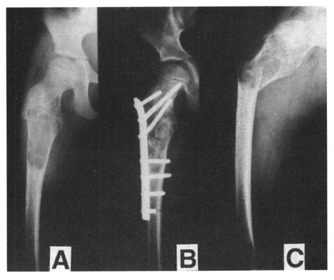 Aneurysmal Bone Cyst The Role Of Fibular Graft In Its Treatment