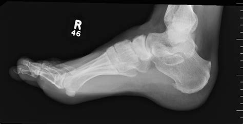 Navicular Fractures The Bone Babe