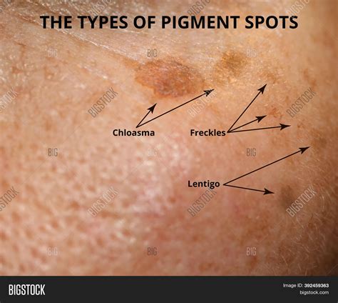 Brown Spot On Skin Image And Photo Free Trial Bigstock