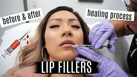 getting lip fillers for the first time lip injections vlog experience laseraway nyc youtube