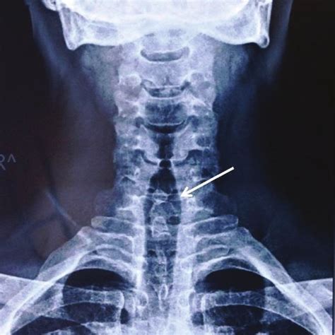 Double Spinous Process Sign In The Ap Cervical X Ray Download