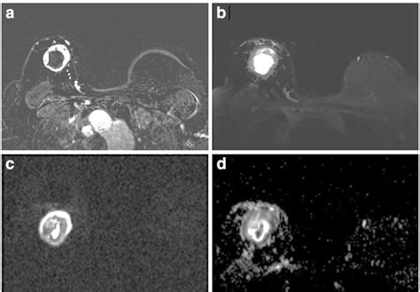 Triple Negative Invasive Ductal Carcinoma Of The Right Breast In A