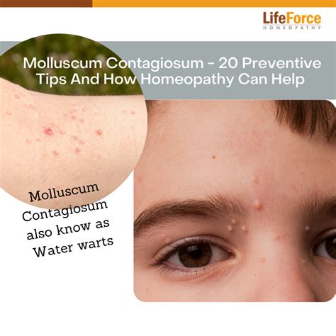 Molluscum Contagiosum 20 Preventive Tips And How Homeopathy Can Help