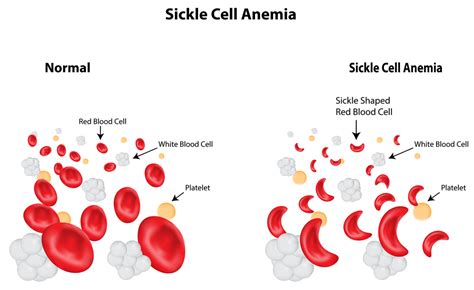 Sickle Cell Anemia Net Health Book