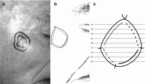 Staged Excision Techniques Plastic Surgery Key