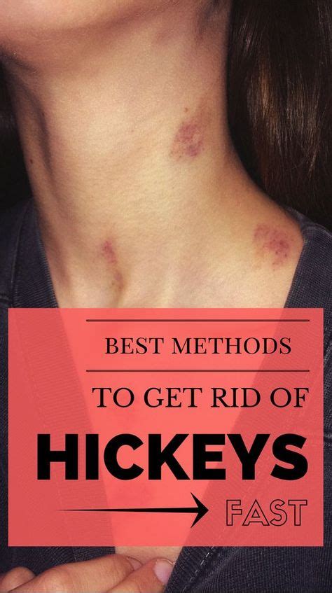Here Are Best Methods To Get Rid Of Hickeys Fast Bath And Body Hickey Remedies Get Rid Of