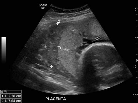 Placental Abruption Ultrasound Hot Sex Picture