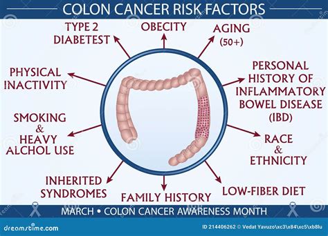 Colon Cancer Disease Risk Factors Infographic Vector Illustration Stock