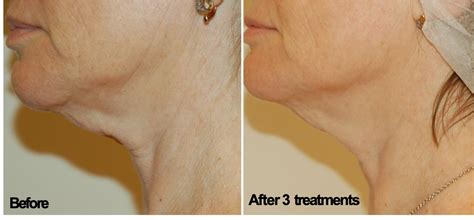 Clearlift Laser Facelift Pulse Laser Aesthetic Clinic