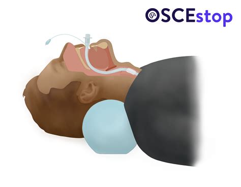 Airway Devices Advanced Oscestop Osce Learning