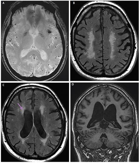 21 Alzheimers Disease Mri Findings Png