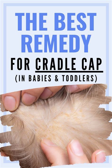 Cradle Cap The Best Way To Get Rid Of It Cradle Cap Remedies Baby