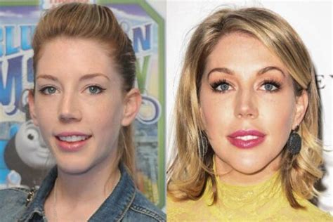 Has Katherine Ryan Had Cosmetic Surgery