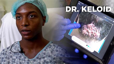 Dr Keloid Patient Gets Keloids Removed From Back Of Head Youtube
