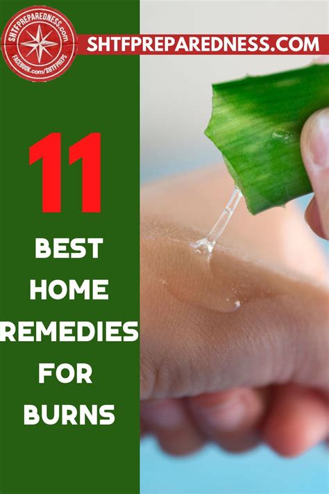 11 Best Home Remedies For Burns Recipe In 2021 Home Remedies For Burns Burn Remedy Home