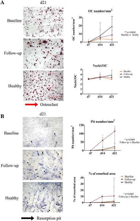 Osteoclast Number Is Reduced In Baseline Patients But Bone Resorption