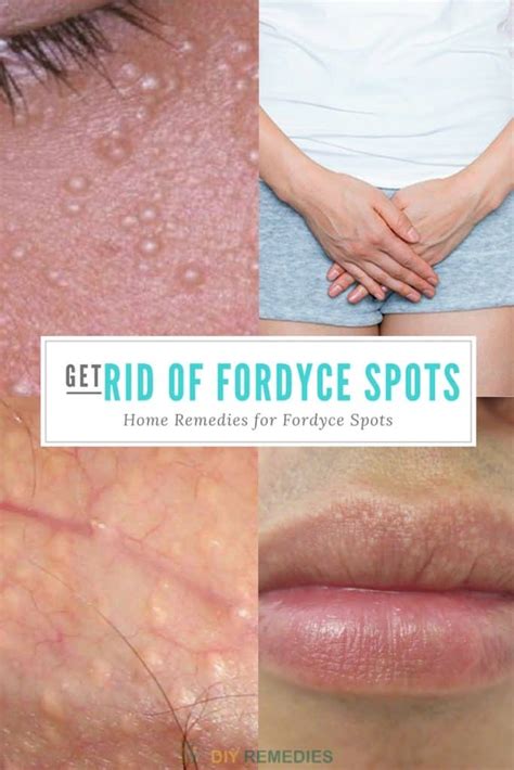 Fordyce Spots On Genital Area