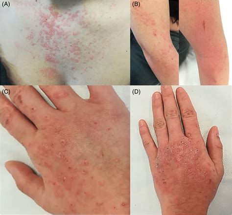 Polymorphous Eruption With Macules Papules Wheals Vesicles Crusts