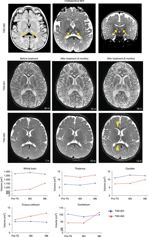 Anatomical Mri Findings In Patients With Tsd Who Were Treated With