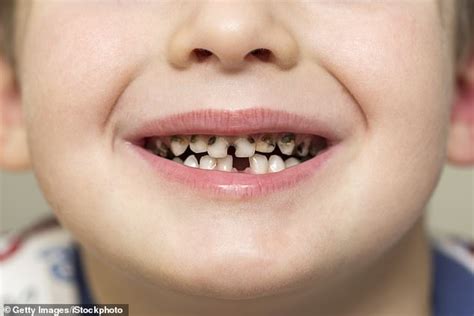 Britains Rotten Teeth Boroughs The Towns And Cities With The Worst