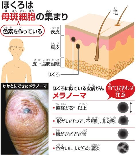 ほくろはなぜできる？ 皮膚がん「メラノーマ」にも注意：朝日新聞デジタル