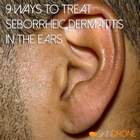9 Ways To Treat Seborrheic Dermatitis In Ears Skin Drone