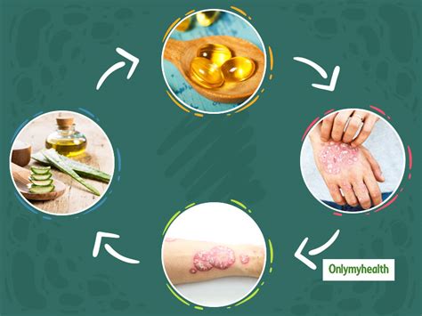 Psoriasis Try These 9 Home Remedies To Treat This Skin Condition