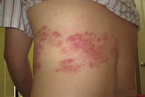 Pictures Of Shingles Rash On Body