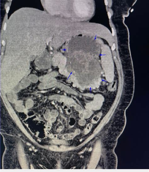 Non Contrast Ct Scan Of The Abdomen In A Coronal Plane Three Months